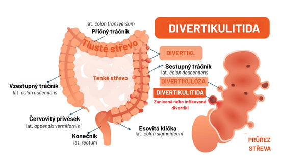 Divertikulitida: Když ve střevě vznikne nežádoucí zánět.
